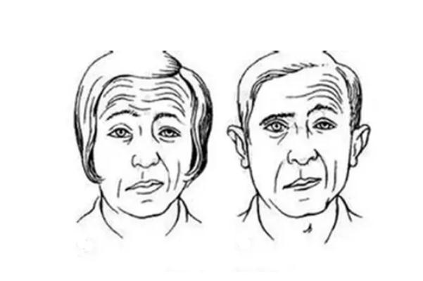 面癱的前兆有哪些癥狀 面癱的自我治療方法 面癱的前兆有哪些癥狀 面癱的自我治療方法