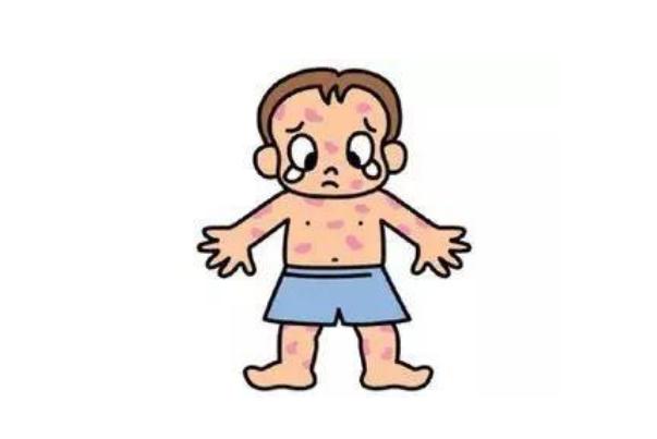 水痘有疫苗嗎 水痘有生命危險嗎 水痘有疫苗嗎 水痘有生命危險嗎