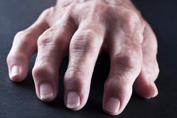 痛風(fēng)要做哪些檢查項目 痛風(fēng)有遺傳性嗎 痛風(fēng)要做哪些檢查項目 痛風(fēng)有遺傳性嗎