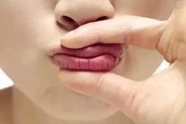 唇炎吃什么維生素 唇炎怎么能徹底治療好 唇炎吃什么維生素 唇炎怎么能徹底治療好