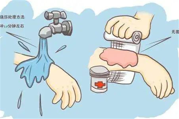 燙傷起水泡了怎么辦 燙傷起水泡要不要挑破