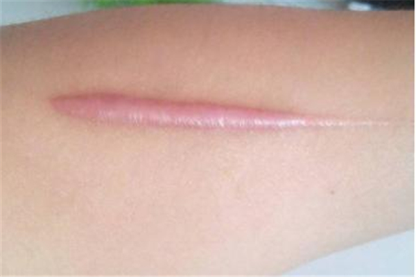 疤痕增生如何消除 疤痕增生是怎么回事 疤痕增生如何消除 疤痕增生是怎么回事