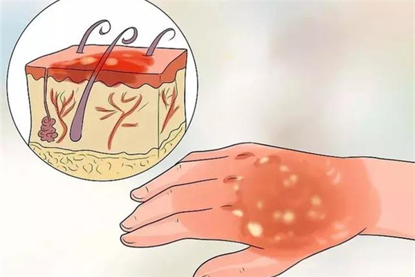 燙傷用牙膏有用嗎 燙傷最好處理方法 燙傷用牙膏有用嗎 燙傷最好處理方法