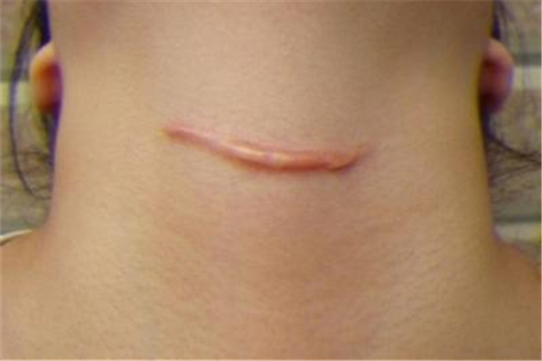 疤痕增生如何消除 疤痕增生是怎么回事 疤痕增生如何消除 疤痕增生是怎么回事