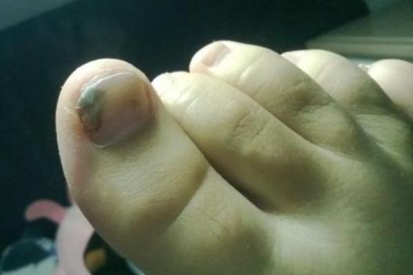 灰指甲要怎么處理 灰指甲要注意什么 灰指甲要怎么處理 灰指甲要注意什么