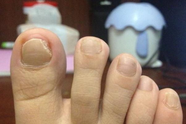 灰指甲要怎么處理 灰指甲要注意什么 灰指甲要怎么處理 灰指甲要注意什么