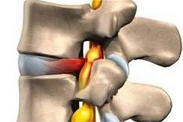 骨質(zhì)增生會壓迫神經(jīng)嗎 骨質(zhì)增生會越來越嚴(yán)重嗎 骨質(zhì)增生會壓迫神經(jīng)嗎 骨質(zhì)增生會越來越嚴(yán)重嗎