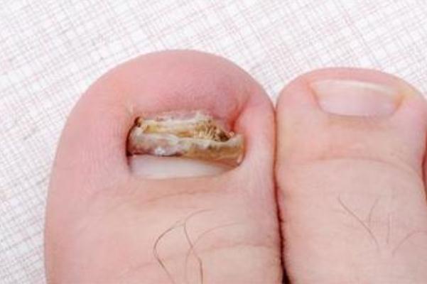 灰指甲要怎么處理 灰指甲要注意什么 灰指甲要怎么處理 灰指甲要注意什么