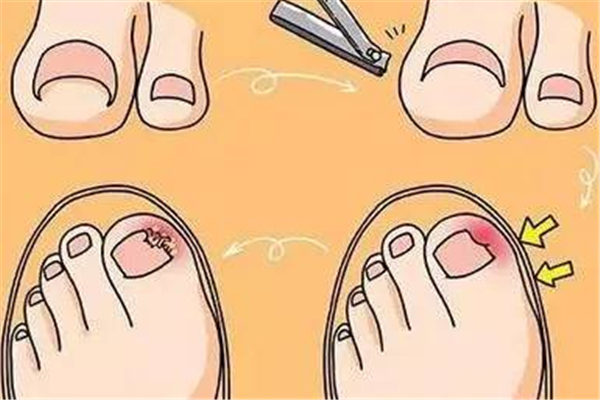 甲溝炎去醫(yī)院掛什么科 甲溝炎去醫(yī)院還是去修腳的地方 甲溝炎去醫(yī)院掛什么科 甲溝炎去醫(yī)院還是去修腳的地方