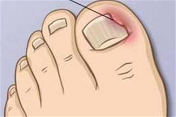 甲溝炎會變成灰指甲嗎 甲溝炎會導(dǎo)致什么后果 甲溝炎會變成灰指甲嗎 甲溝炎會導(dǎo)致什么后果