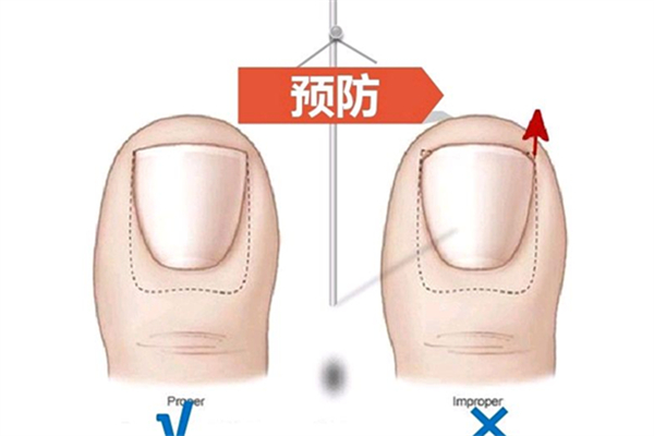 甲溝炎會變成灰指甲嗎 甲溝炎會導(dǎo)致什么后果 甲溝炎會變成灰指甲嗎 甲溝炎會導(dǎo)致什么后果