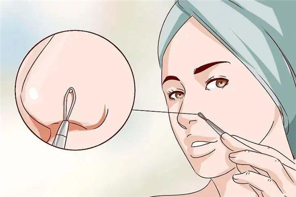 黑頭毛孔粗大怎么辦 黑頭會(huì)導(dǎo)致毛孔粗大嗎 黑頭毛孔粗大怎么辦 黑頭會(huì)導(dǎo)致毛孔粗大嗎