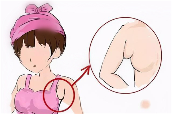 副乳切除好還是不切 副乳切除會(huì)留疤嗎 副乳切除好還是不切 副乳切除會(huì)留疤嗎