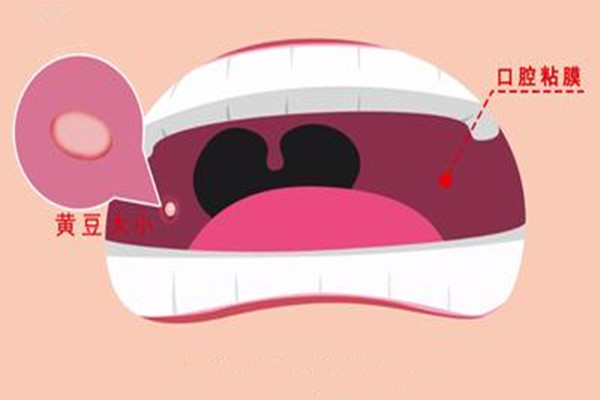 口腔潰瘍會(huì)引起口臭嗎 口腔潰瘍會(huì)引起口腔癌嗎 口腔潰瘍會(huì)引起口臭嗎 口腔潰瘍會(huì)引起口腔癌嗎