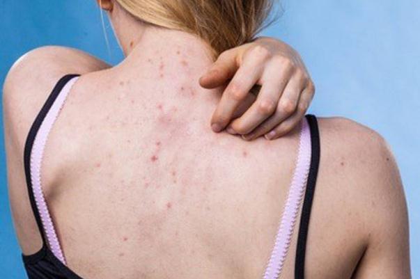 濕氣重是不是愛(ài)出汗 濕氣重是不是要少喝水 濕氣重是不是愛(ài)出汗 濕氣重是不是要少喝水