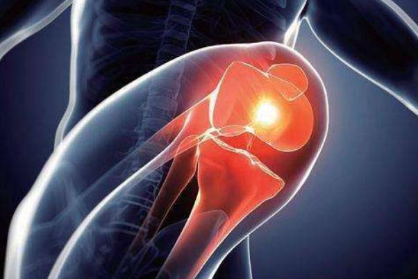 關節(jié)炎是缺鈣引起的嗎 關節(jié)炎是遺傳病嗎 關節(jié)炎是缺鈣引起的嗎 關節(jié)炎是遺傳病嗎