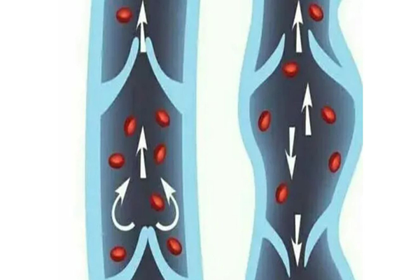 靜脈曲張會(huì)自己消失嗎 靜脈曲張嚴(yán)重的后果會(huì)怎樣 靜脈曲張會(huì)自己消失嗎 靜脈曲張嚴(yán)重的后果會(huì)怎樣