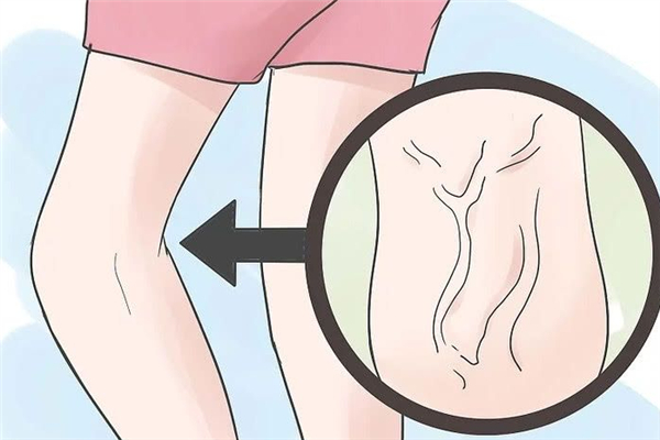 靜脈曲張是怎么引起的 靜脈曲張的表現(xiàn)癥狀 靜脈曲張是怎么引起的 靜脈曲張的表現(xiàn)癥狀