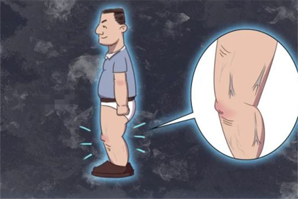 靜脈曲張會死人嗎 靜脈曲張用什么辦法治療最好 靜脈曲張會死人嗎 靜脈曲張用什么辦法治療最好