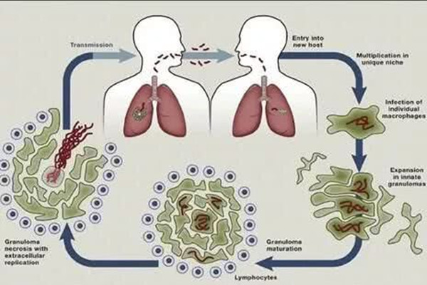 肺結(jié)核有潛伏期嗎 肺結(jié)核有沒有疫苗 肺結(jié)核有潛伏期嗎 肺結(jié)核有沒有疫苗