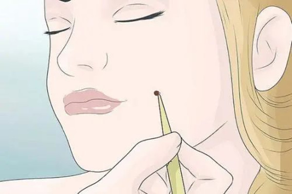 點痣可以化妝嗎 點痣可以敷面膜嗎 點痣可以化妝嗎 點痣可以敷面膜嗎