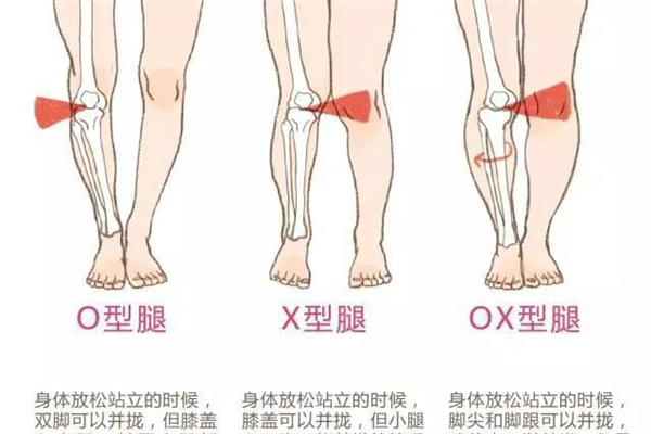 腿型不直可以矯正嗎 腿型不直怎么矯正 腿型不直可以矯正嗎 腿型不直怎么矯正