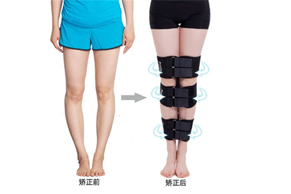 腿型不直可以矯正嗎 腿型不直怎么矯正 腿型不直可以矯正嗎 腿型不直怎么矯正