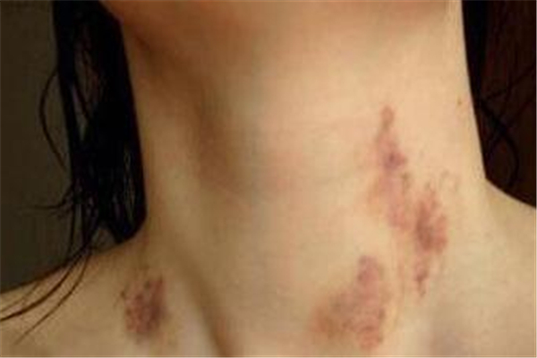 種草莓在脖子上的危害 種草莓在脖子哪個(gè)位置最安全