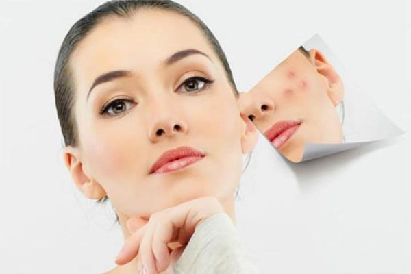 果酸換膚會結痂嗎 果酸換膚后摳掉痂皮會留疤嗎