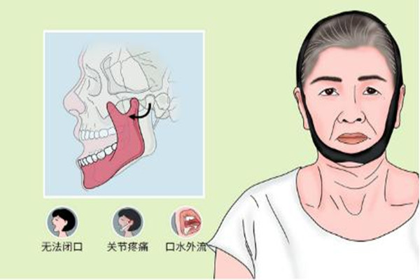 下巴脫臼是什么感覺(jué) 下巴脫臼是什么原因