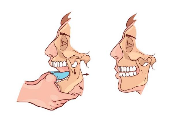脫臼是什么意思 下巴脫臼怎么辦自救 脫臼是什么意思 下巴脫臼怎么辦自救