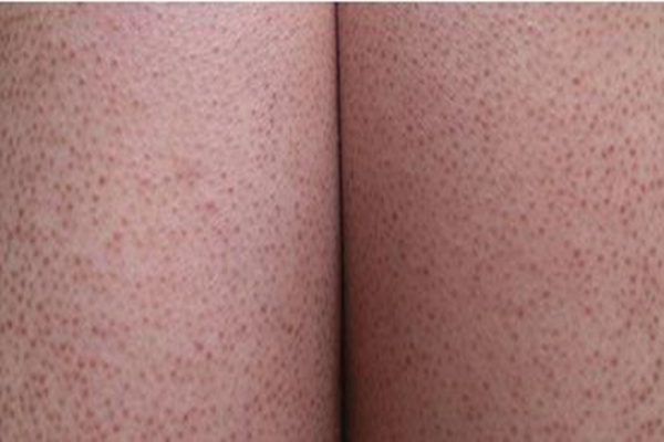 雞皮膚要補(bǔ)充什么維生素 雞皮膚吃什么能改善 雞皮膚要補(bǔ)充什么維生素 雞皮膚吃什么能改善