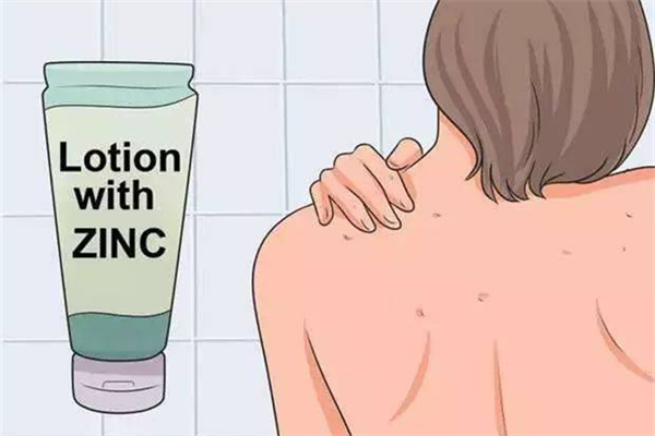 雞皮膚會隨著年齡的增長消除嗎 雞皮膚用什么藥膏最好 雞皮膚會隨著年齡的增長消除嗎 雞皮膚用什么藥膏最好