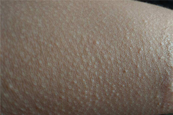 雞皮膚對健康有影響嗎 雞皮膚有什么危害 雞皮膚對健康有影響嗎 雞皮膚有什么危害