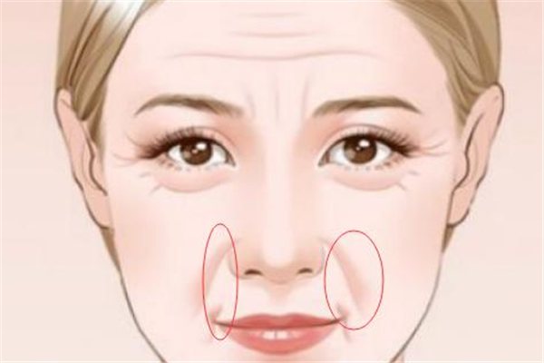 法令紋會徹底消除嗎 天生的法令紋能去掉嗎 法令紋會徹底消除嗎 天生的法令紋能去掉嗎