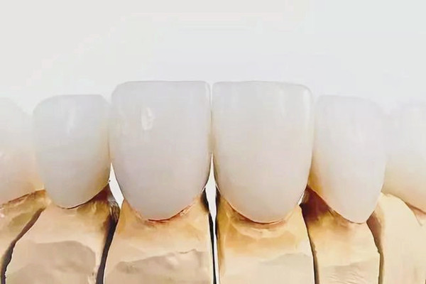 烤瓷牙需要磨牙嗎 烤瓷牙需要更換嗎 烤瓷牙需要磨牙嗎 烤瓷牙需要更換嗎