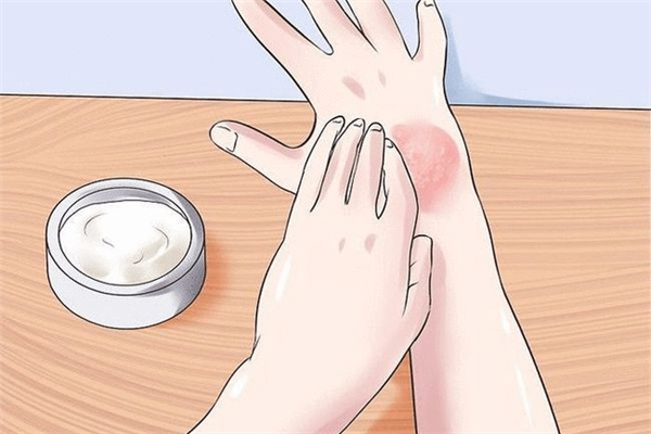 凍瘡年年復(fù)發(fā)什么辦 凍瘡復(fù)發(fā)的原因 凍瘡年年復(fù)發(fā)什么辦 凍瘡復(fù)發(fā)的原因