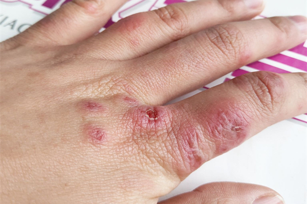 凍瘡發(fā)癢是什么階段 凍瘡發(fā)癢怎么辦 凍瘡發(fā)癢是什么階段 凍瘡發(fā)癢怎么辦