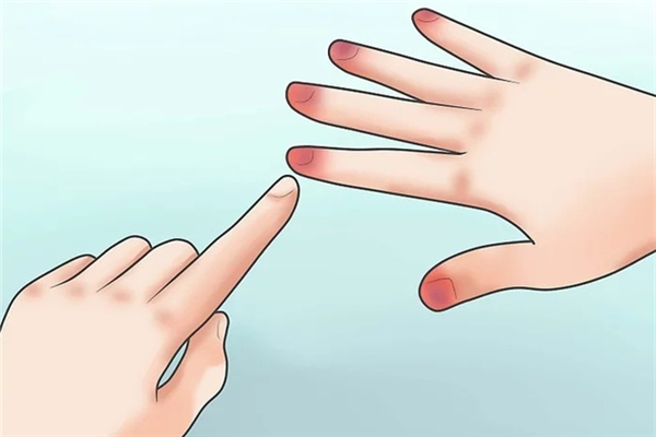 凍瘡可以涂紅霉素軟膏嗎 凍瘡?fù)刻J薈膠有用嗎 凍瘡可以涂紅霉素軟膏嗎 凍瘡?fù)刻J薈膠有用嗎