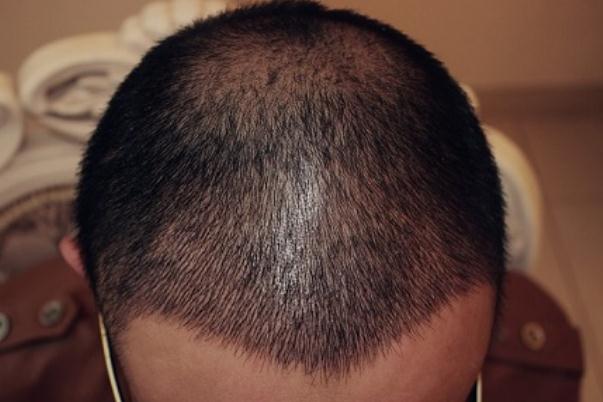 植發(fā)對(duì)身體健康有影響嗎 植發(fā)對(duì)頭皮有傷害嗎 植發(fā)對(duì)身體健康有影響嗎 植發(fā)對(duì)頭皮有傷害嗎