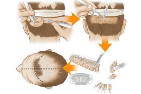 植發(fā)是用自己的頭發(fā)移植嗎 植發(fā)的危害和后遺癥 植發(fā)是用自己的頭發(fā)移植嗎 植發(fā)的危害和后遺癥