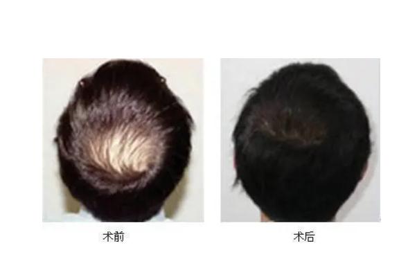 植發(fā)會自己生長嗎 植發(fā)會失敗嗎 植發(fā)會自己生長嗎 植發(fā)會失敗嗎