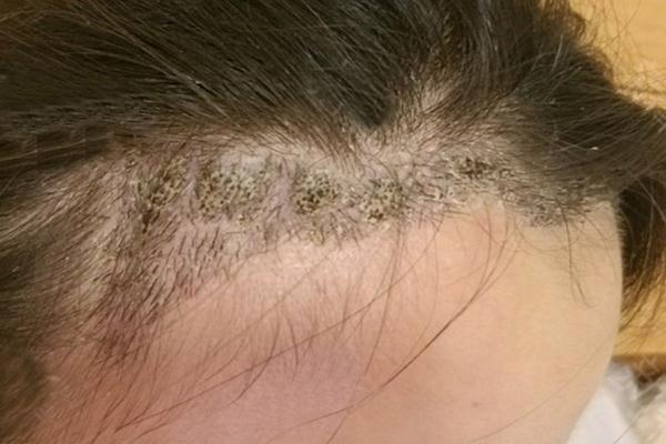 植發(fā)是永久性的嗎 植發(fā)是拆東墻補西墻嗎 植發(fā)是永久性的嗎 植發(fā)是拆東墻補西墻嗎