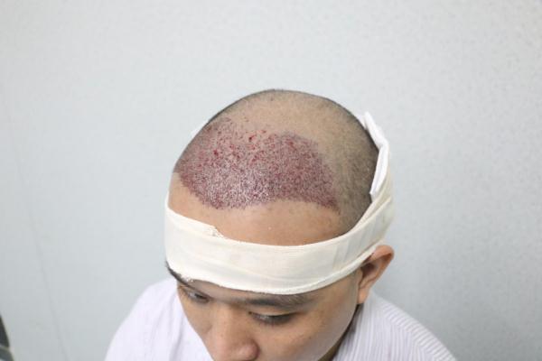 植發(fā)會自己生長嗎 植發(fā)會失敗嗎 植發(fā)會自己生長嗎 植發(fā)會失敗嗎