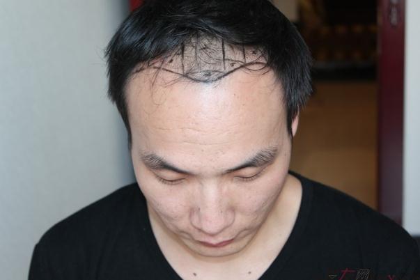 植發(fā)對(duì)身體健康有影響嗎 植發(fā)對(duì)頭皮有傷害嗎 植發(fā)對(duì)身體健康有影響嗎 植發(fā)對(duì)頭皮有傷害嗎