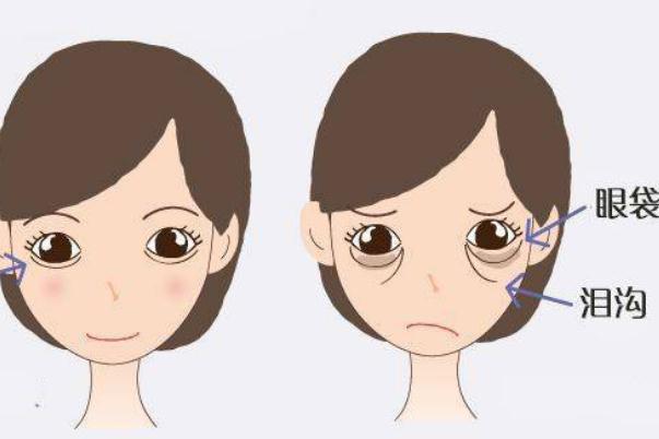 眼袋為什么是青黑色 眼袋為什么早上冰敷晚上熱敷 眼袋為什么是青黑色 眼袋為什么早上冰敷晚上熱敷