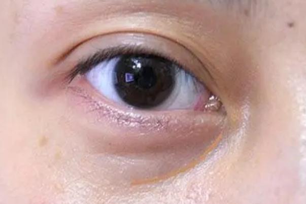 眼袋怎么去除最有效果 眼袋的形成原因 眼袋怎么去除最有效果 眼袋的形成原因