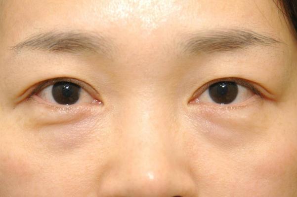 眼袋為什么是青黑色 眼袋為什么早上冰敷晚上熱敷 眼袋為什么是青黑色 眼袋為什么早上冰敷晚上熱敷