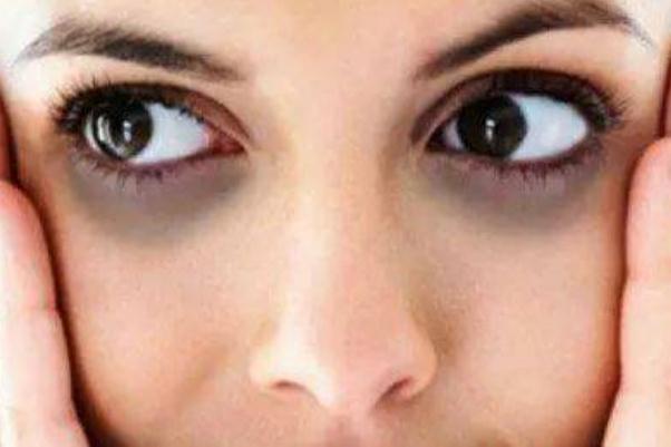 眼袋為什么有脂肪粒 眼袋為什么一個大一個小 眼袋為什么有脂肪粒 眼袋為什么一個大一個小