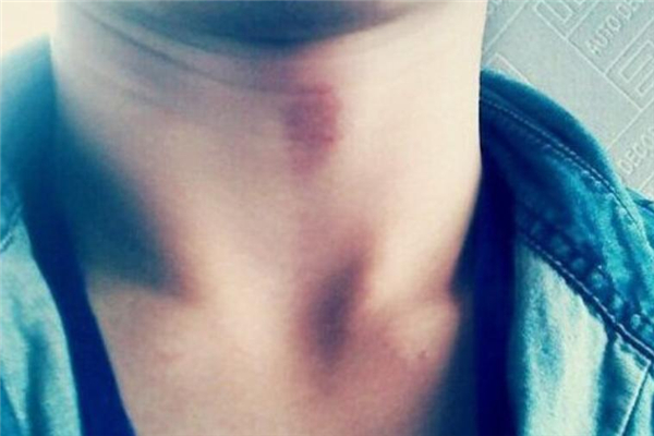 吻痕用雞蛋熱敷管用嗎 吻痕用雞蛋敷過后什么時(shí)候能消 吻痕用雞蛋熱敷管用嗎 吻痕用雞蛋敷過后什么時(shí)候能消